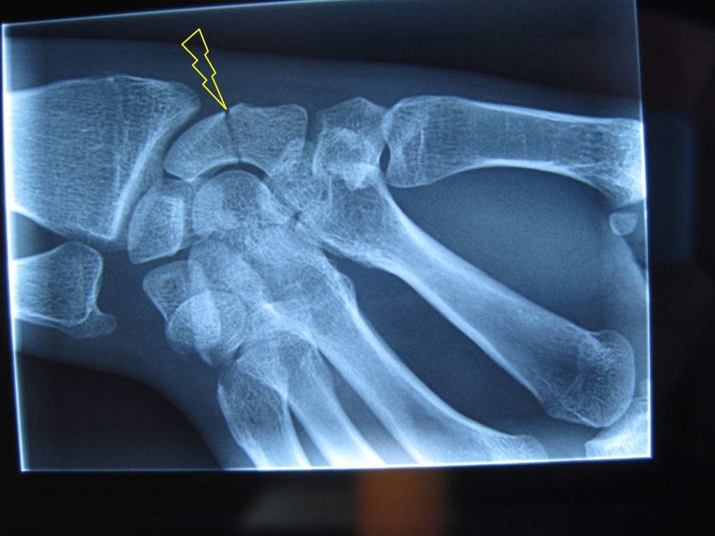 Fracture du scaphoïde  Clinique du sport